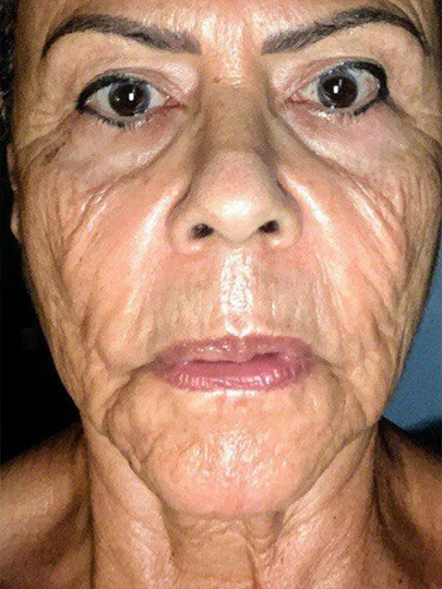 Marina, 68 anos · 40 dias, antes