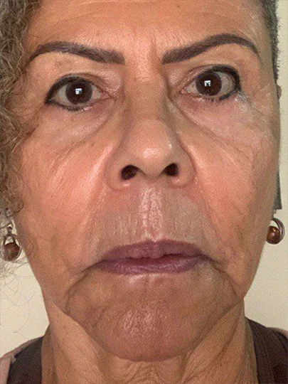 Marina, 68 anos · 40 dias, depois
