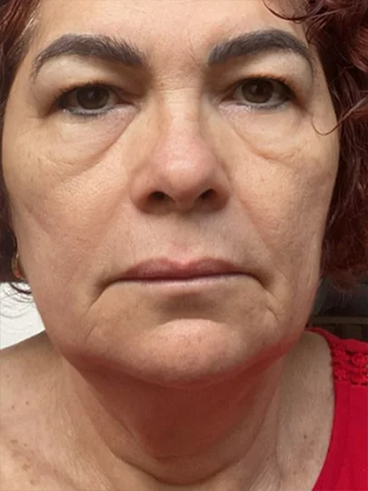 Lindalva, 61 anos · 40 dias, antes