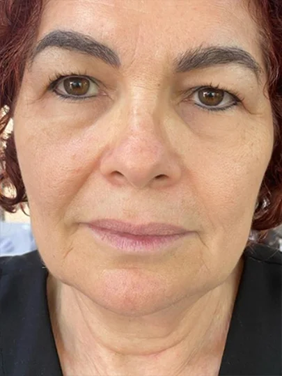 Lindalva, 61 anos · 40 dias, depois