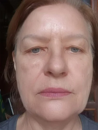 Monica, 64 anos · 26 dias, depois