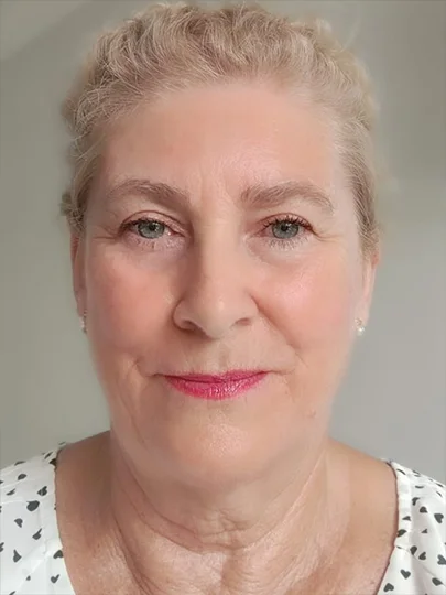 Marlene, 70 anos, depois