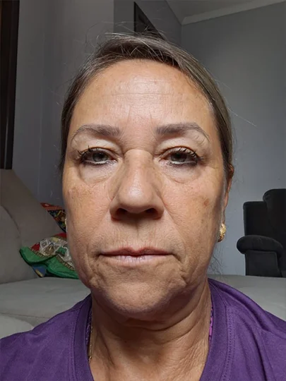 Eliane, 61 anos, antes