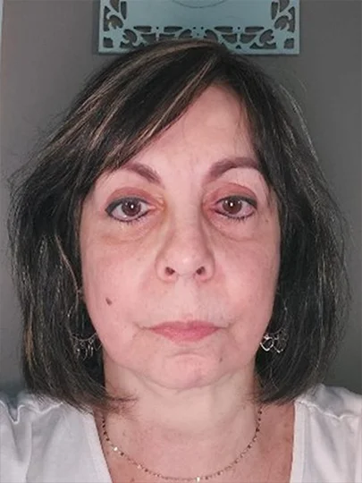 Elaine, 65 anos · 40 dias, antes