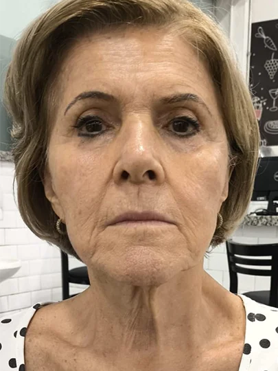 Lucia, 76 anos · 40 dias, antes