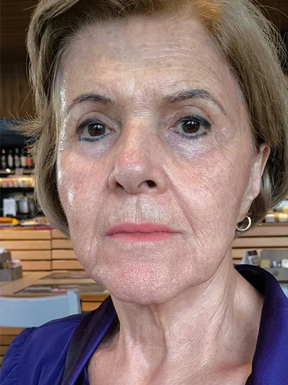 Lucia, 76 anos · 40 dias, depois