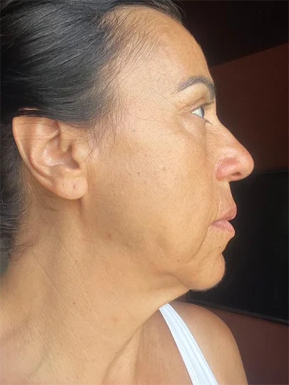 Sandra, 58 anos, depois