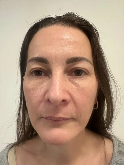 Andrea, 50 anos, antes
